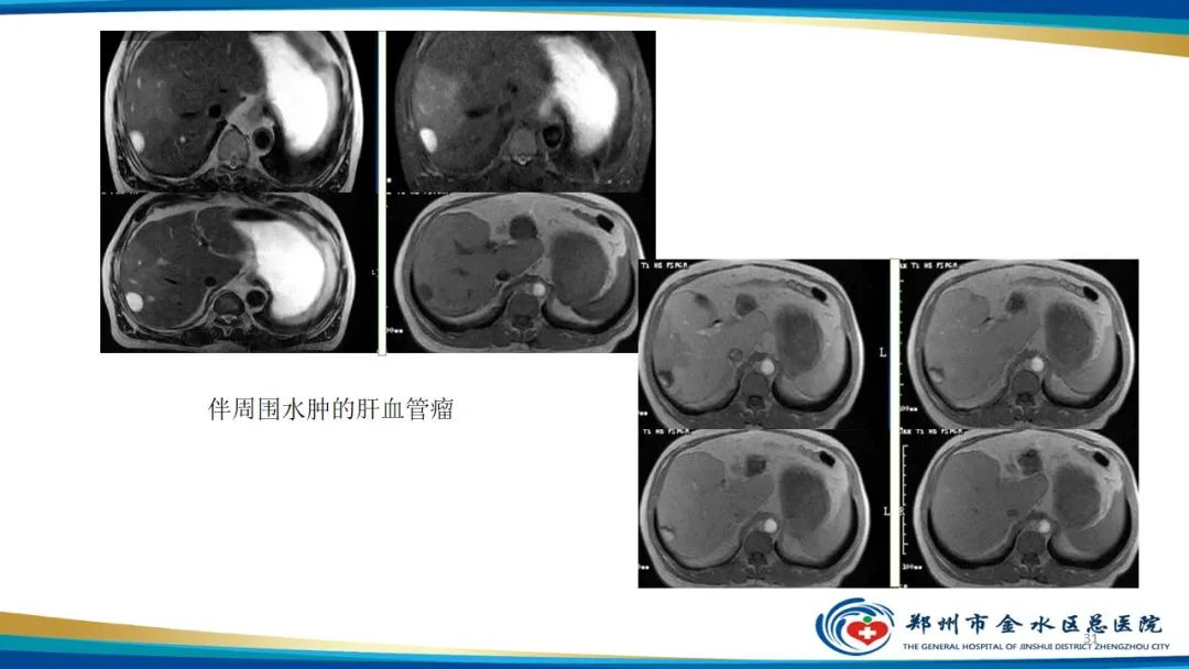 影像PPT - 【PPT】肝血管瘤影像学表现-31