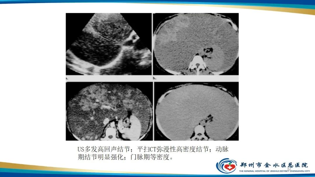 影像PPT - 【PPT】肝血管瘤影像学表现-32