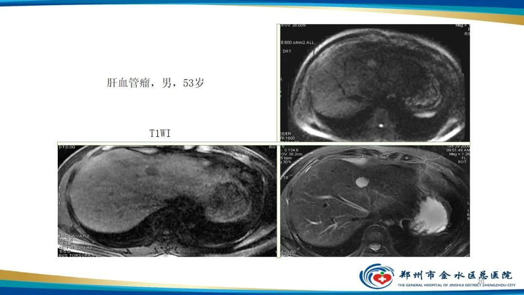 影像PPT - 【PPT】肝血管瘤影像学表现-20