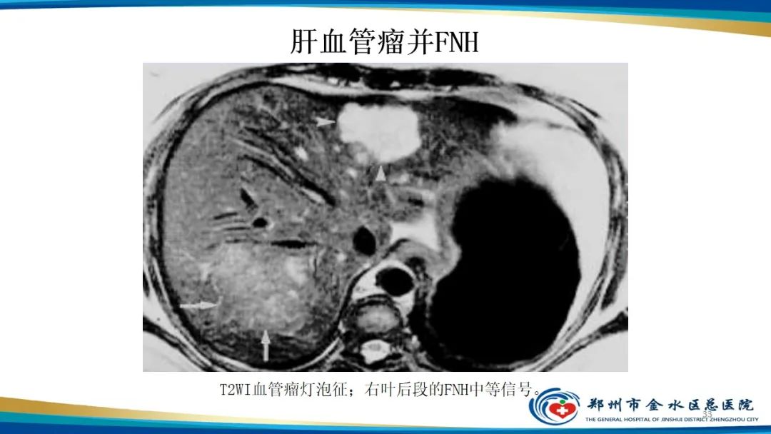 影像PPT - 【PPT】肝血管瘤影像学表现-33