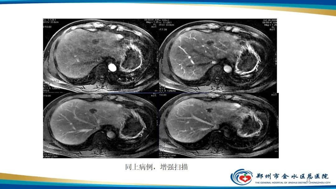 影像PPT - 【PPT】肝血管瘤影像学表现-21