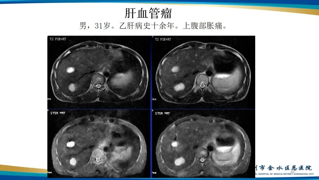 影像PPT - 【PPT】肝血管瘤影像学表现-42