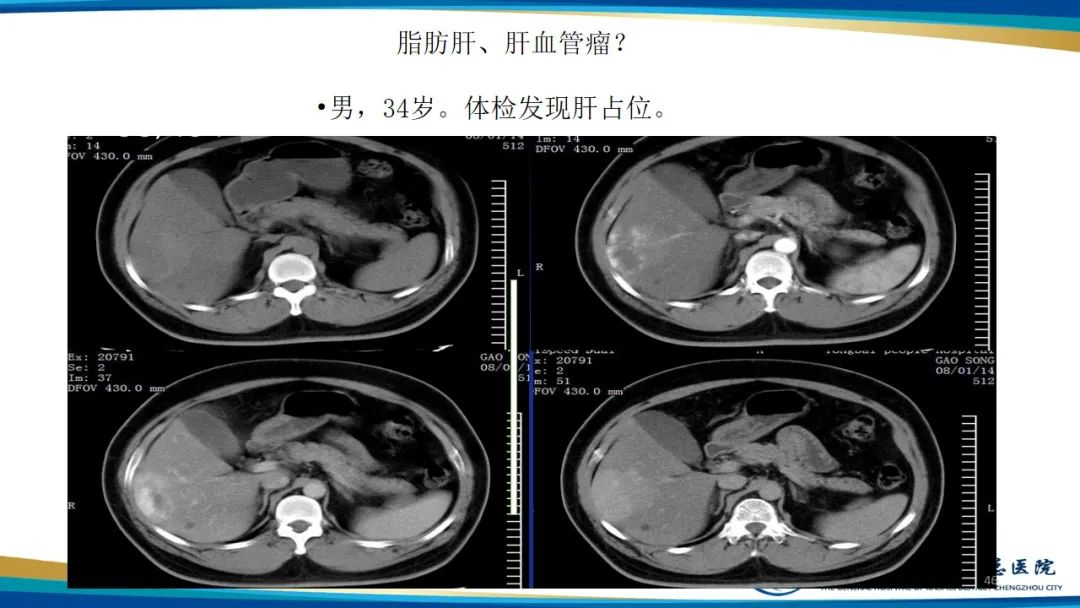 影像PPT - 【PPT】肝血管瘤影像学表现-46