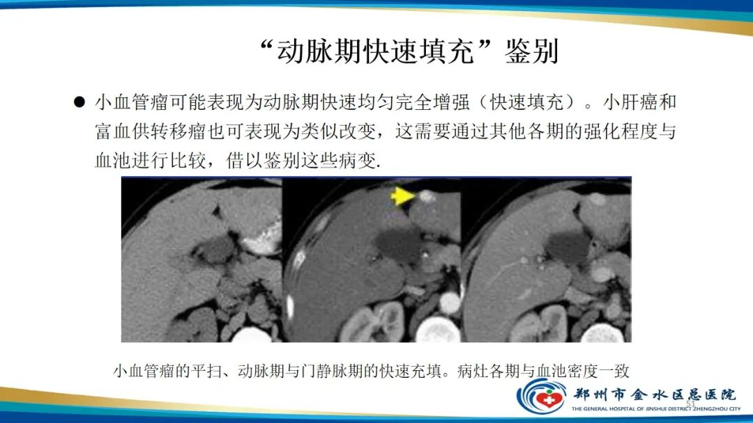 影像PPT - 【PPT】肝血管瘤影像学表现-51