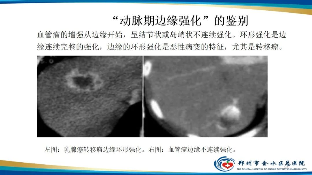 影像PPT - 【PPT】肝血管瘤影像学表现-53