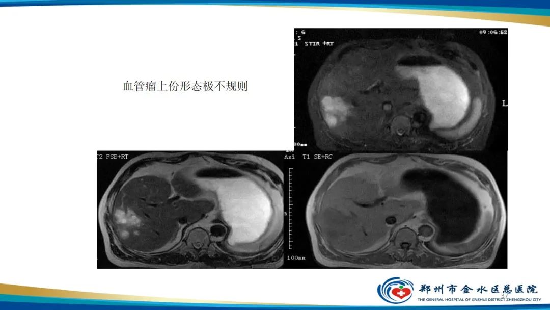 影像PPT - 【PPT】肝血管瘤影像学表现-37