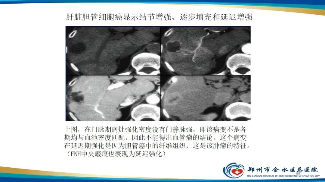影像PPT - 【PPT】肝血管瘤影像学表现-55