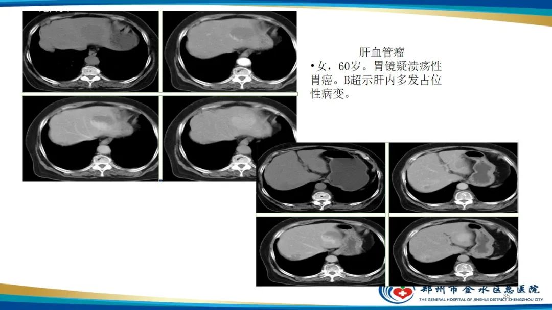 影像PPT - 【PPT】肝血管瘤影像学表现-35