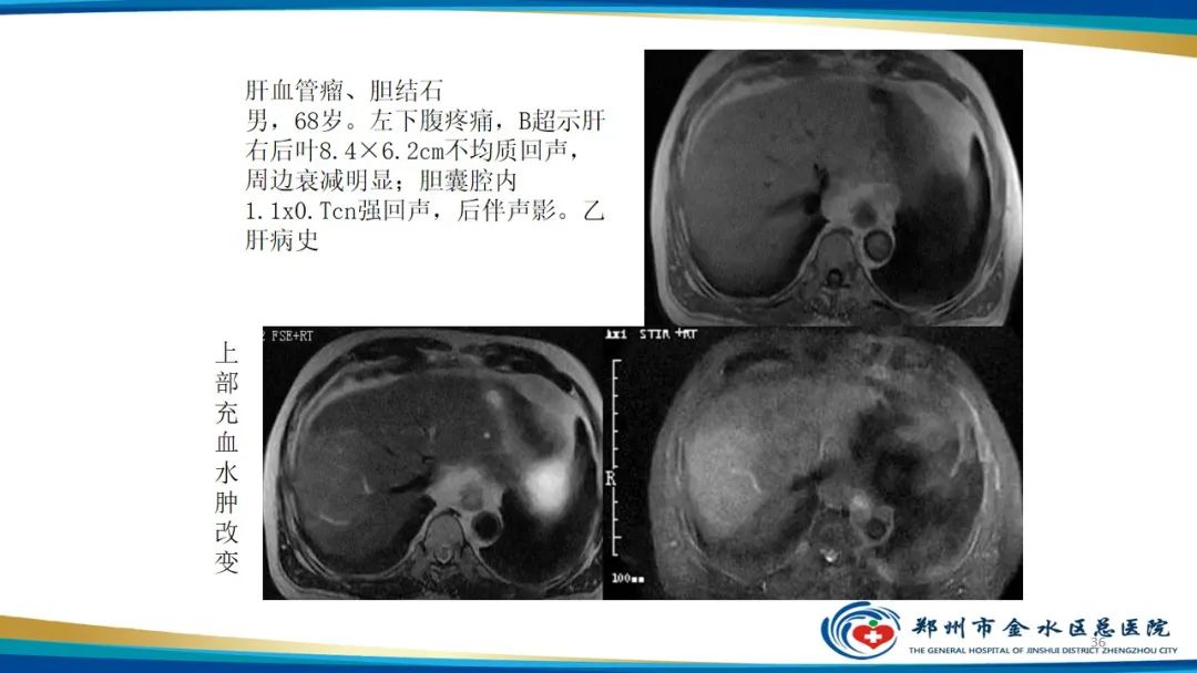 影像PPT - 【PPT】肝血管瘤影像学表现-36