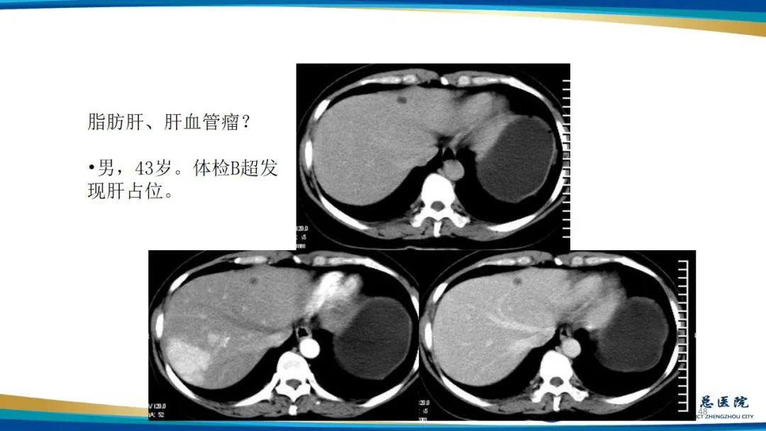 影像PPT - 【PPT】肝血管瘤影像学表现-48