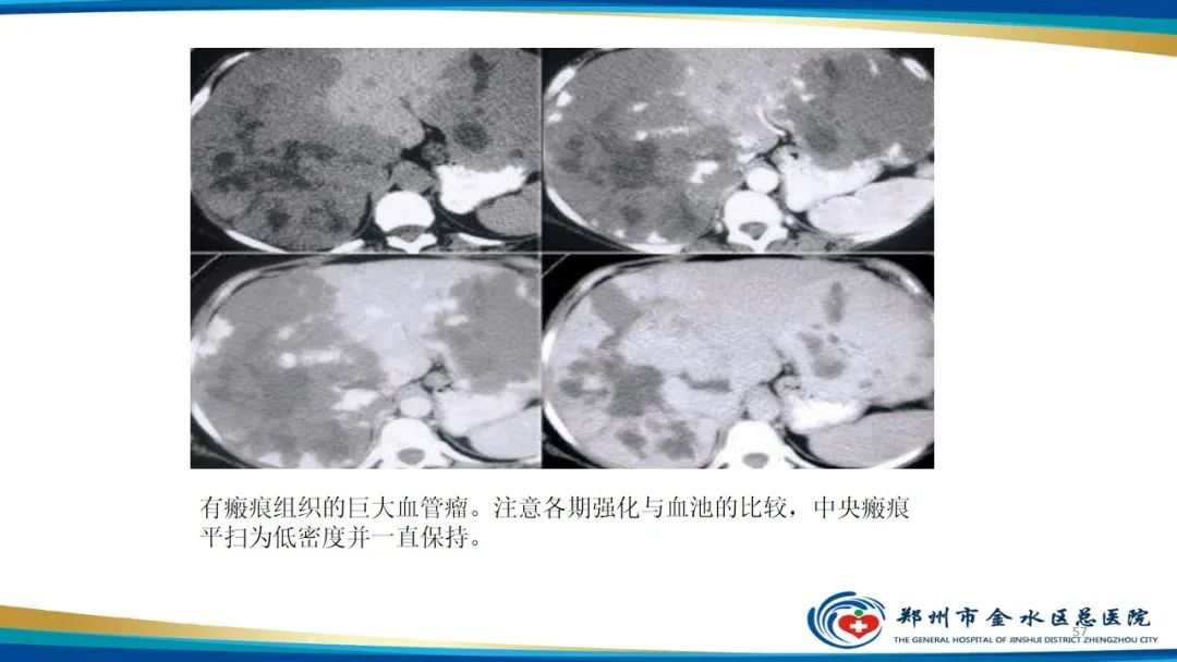 影像PPT - 【PPT】肝血管瘤影像学表现-57