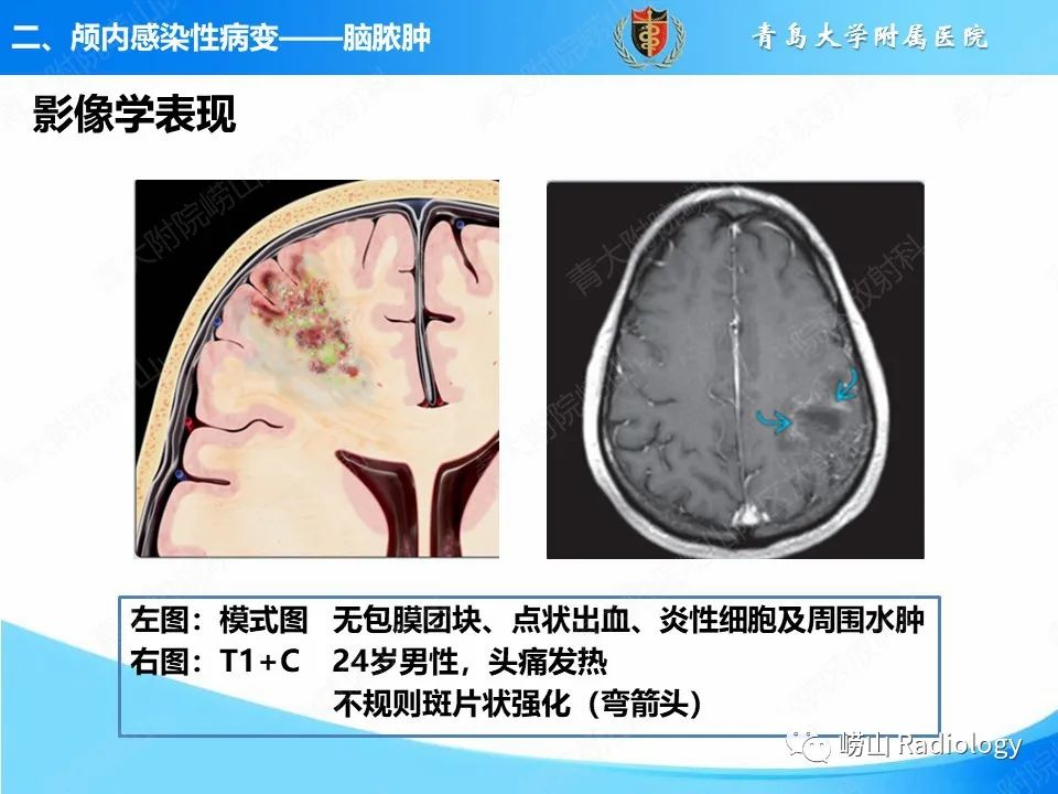 影像PPT - 【PPT】颅内感染性疾病-7