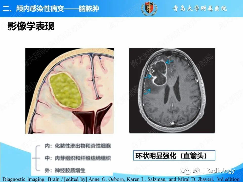 影像PPT - 【PPT】颅内感染性疾病-9