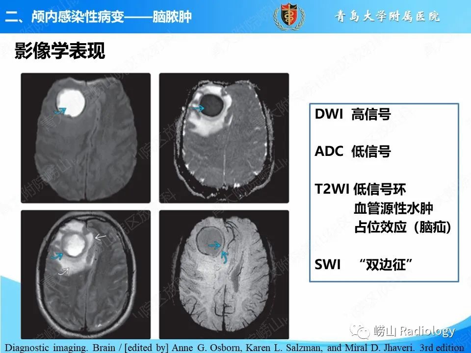 影像PPT - 【PPT】颅内感染性疾病-10
