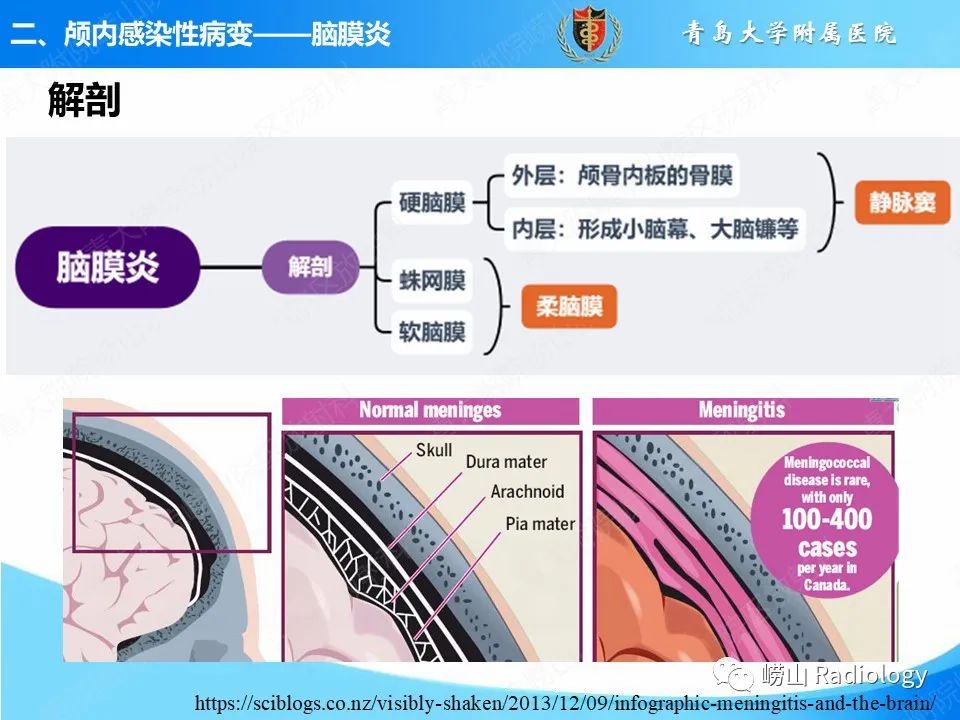 影像PPT - 【PPT】颅内感染性疾病-13