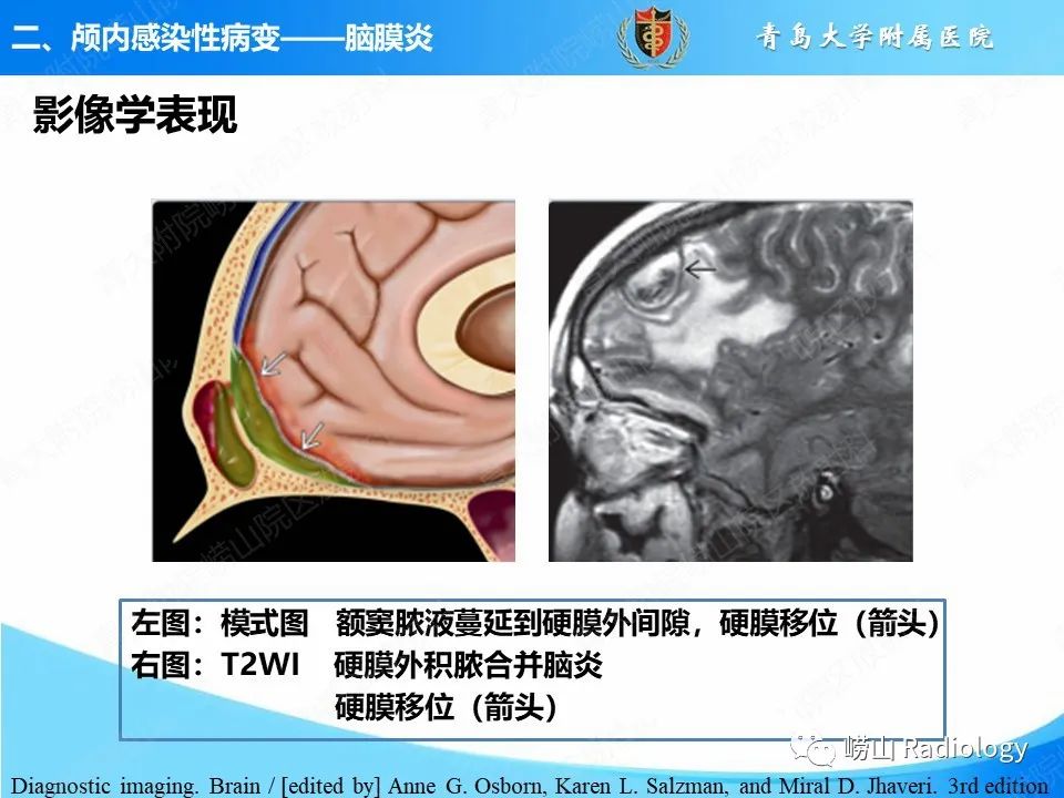 影像PPT - 【PPT】颅内感染性疾病-16