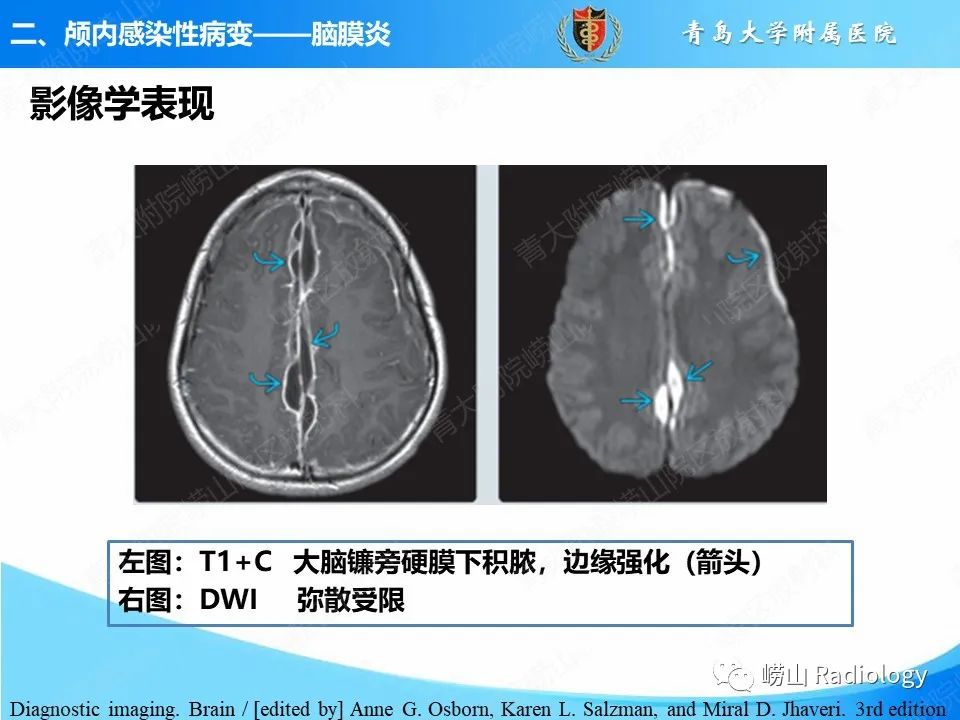 影像PPT - 【PPT】颅内感染性疾病-17