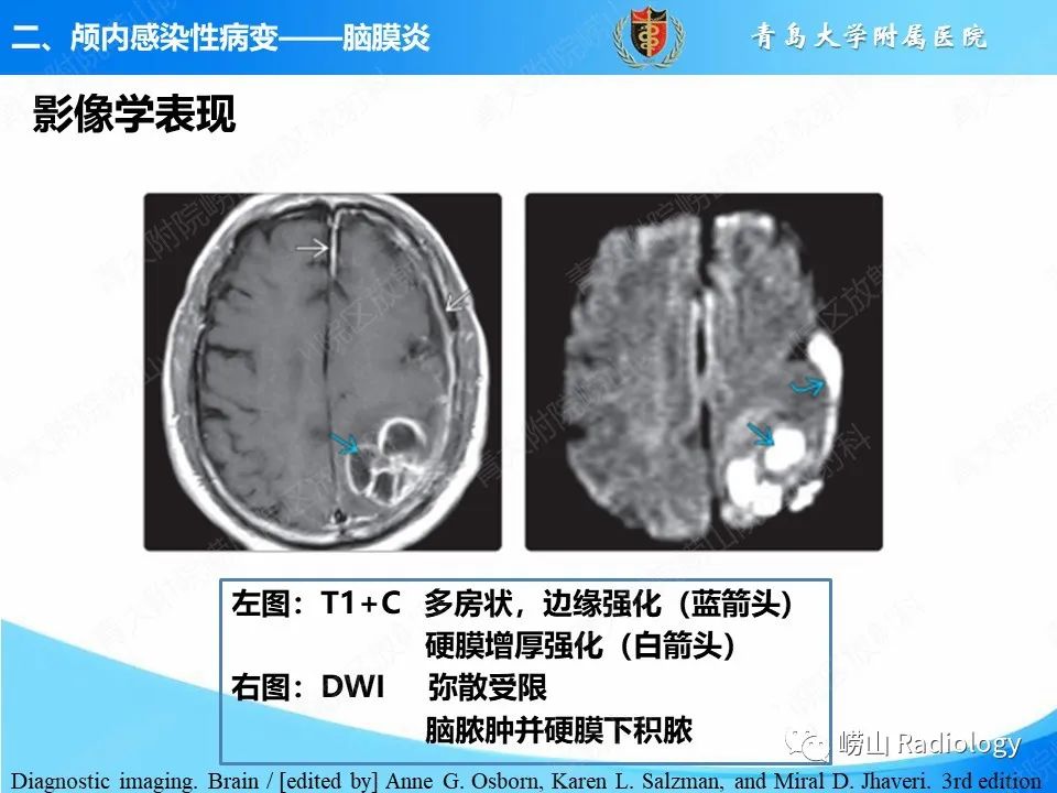 影像PPT - 【PPT】颅内感染性疾病-18