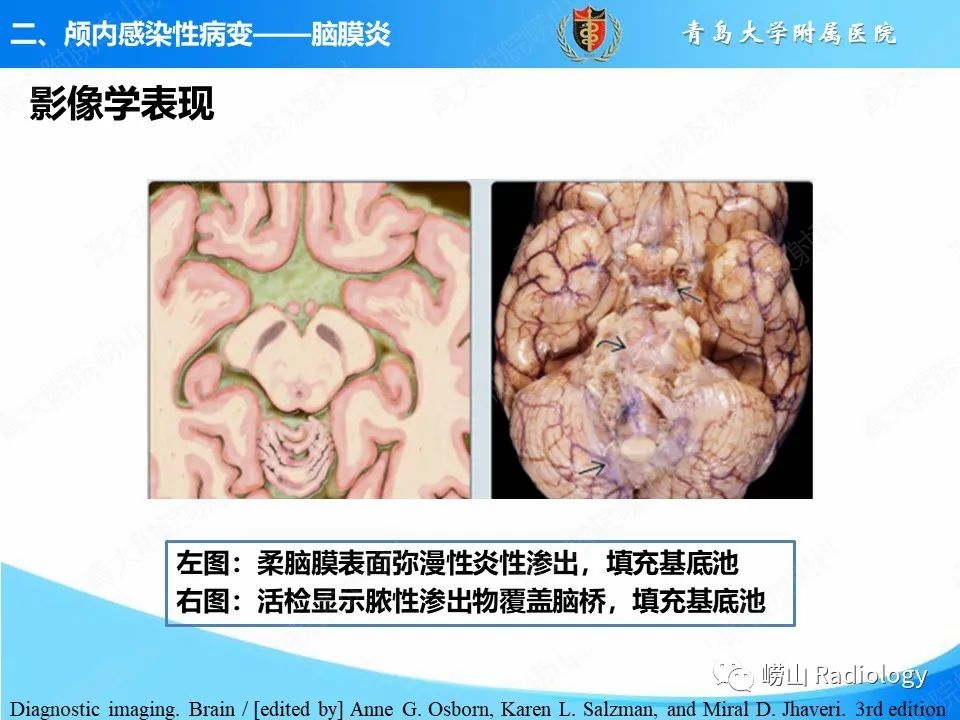 影像PPT - 【PPT】颅内感染性疾病-20