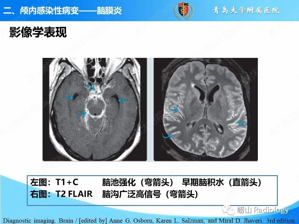 影像PPT - 【PPT】颅内感染性疾病-21