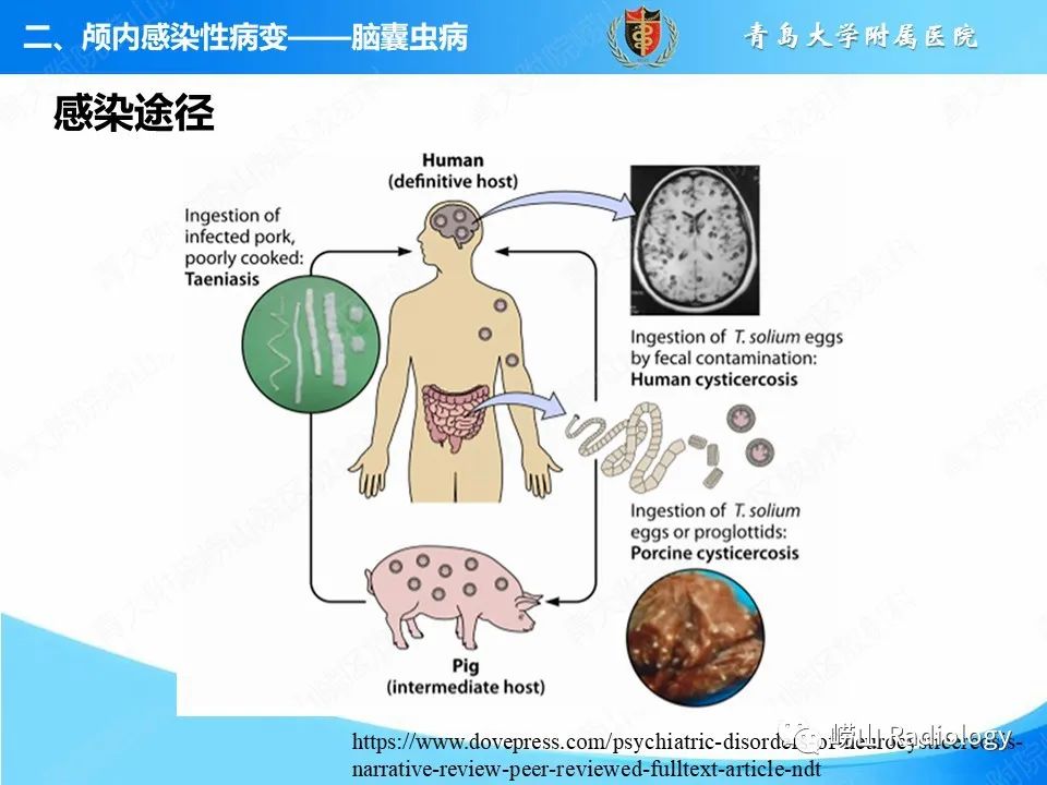 影像PPT - 【PPT】颅内感染性疾病-23