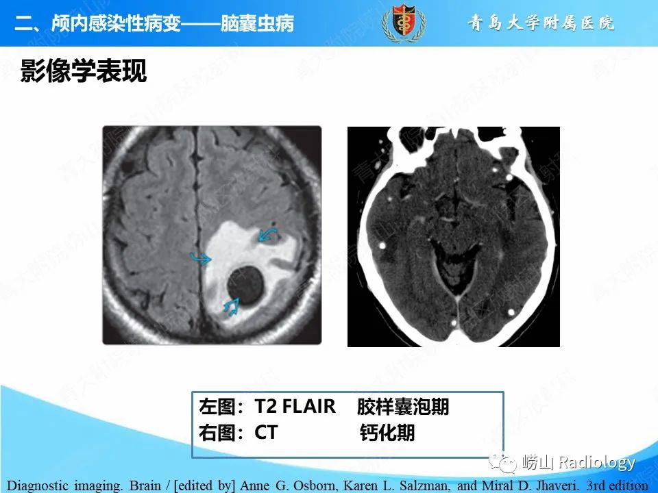 影像PPT - 【PPT】颅内感染性疾病-29