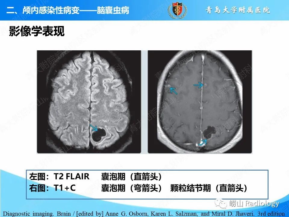 影像PPT - 【PPT】颅内感染性疾病-28