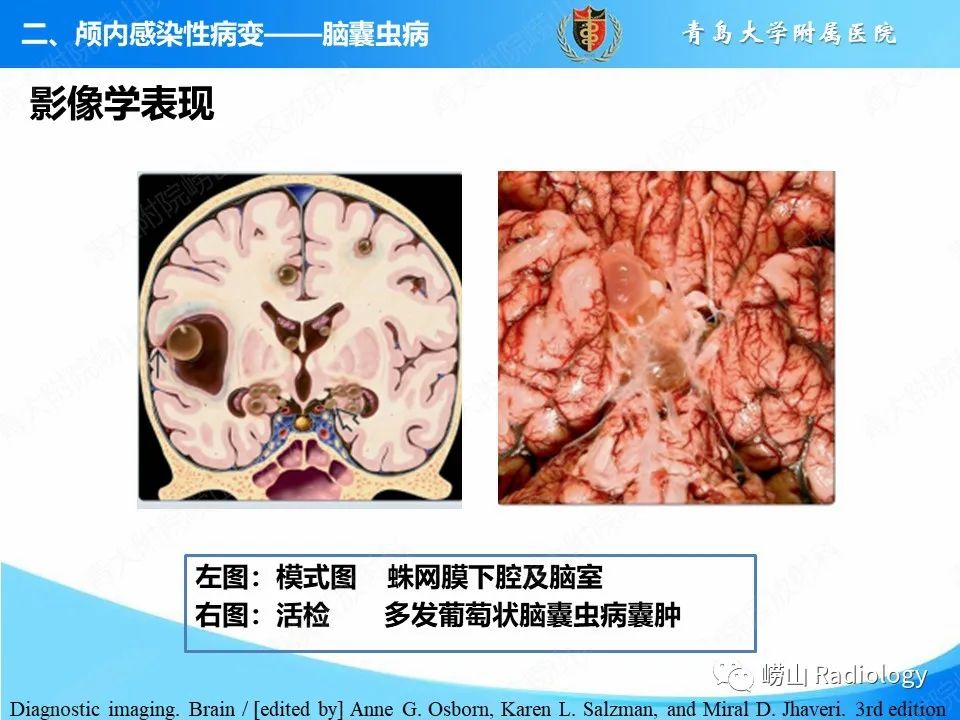 影像PPT - 【PPT】颅内感染性疾病-31