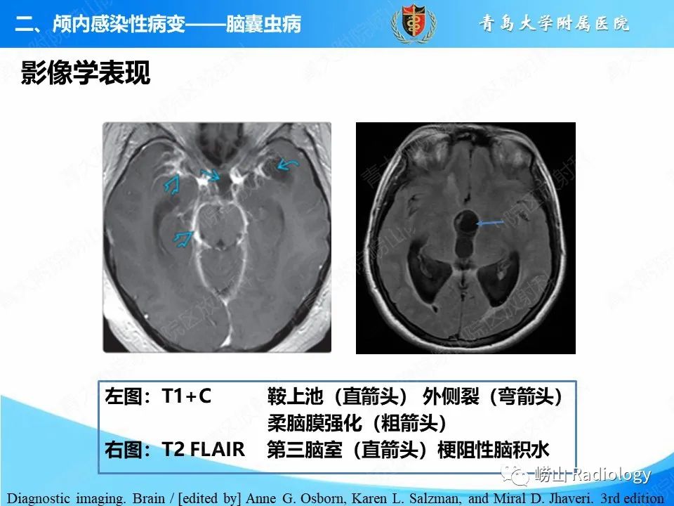 影像PPT - 【PPT】颅内感染性疾病-32