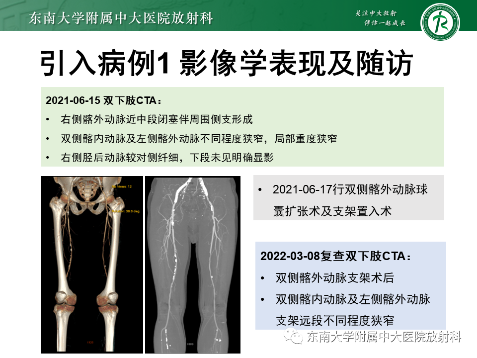 影像PPT - 【PPT】下肢动脉硬化闭塞症-2 影像PPT - 【PPT】下肢动脉硬化闭塞症-2