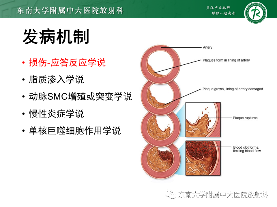 影像PPT - 【PPT】下肢动脉硬化闭塞症-8 影像PPT - 【PPT】下肢动脉硬化闭塞症-8