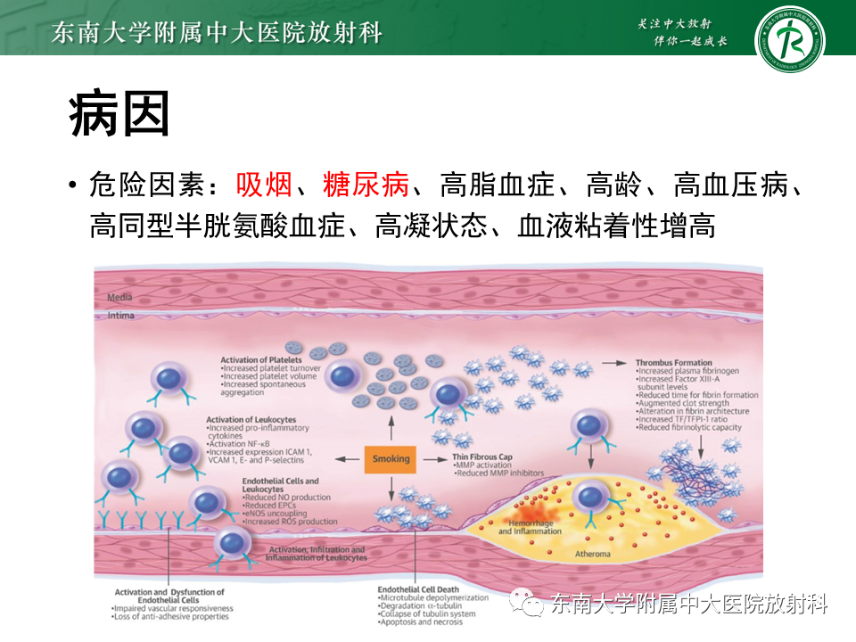 影像PPT - 【PPT】下肢动脉硬化闭塞症-7 影像PPT - 【PPT】下肢动脉硬化闭塞症-7