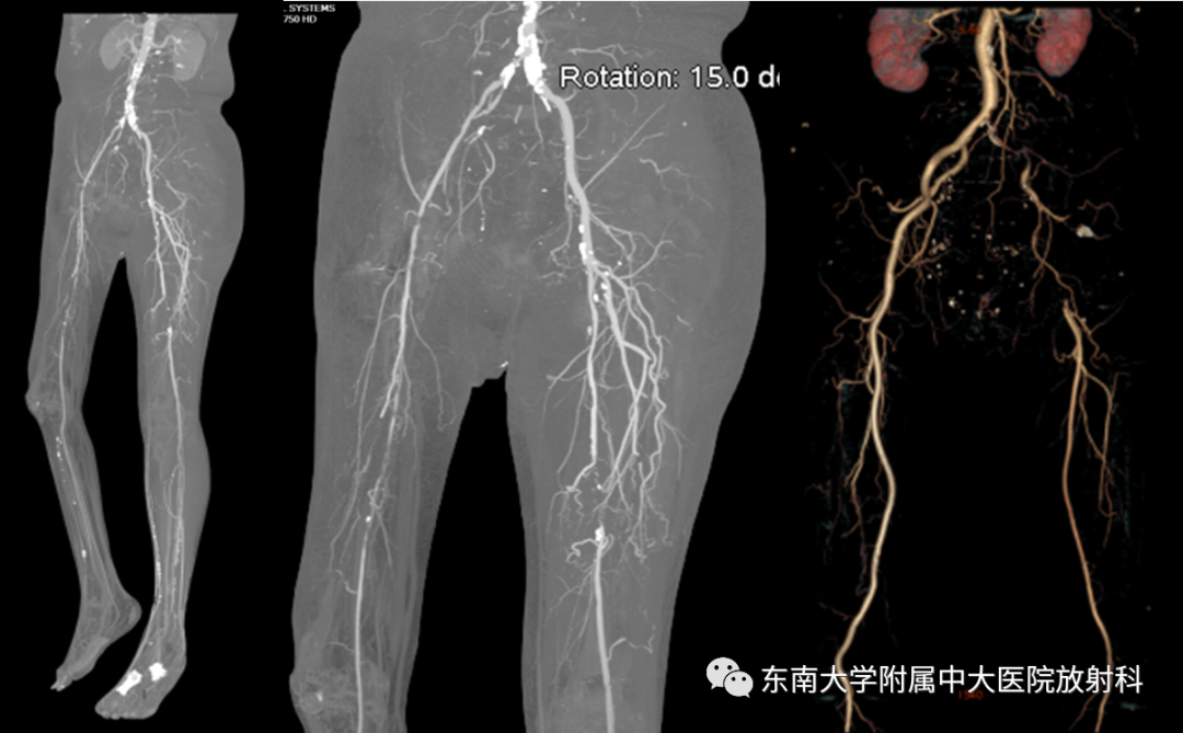 影像PPT - 【PPT】下肢动脉硬化闭塞症-1 影像PPT - 【PPT】下肢动脉硬化闭塞症-1