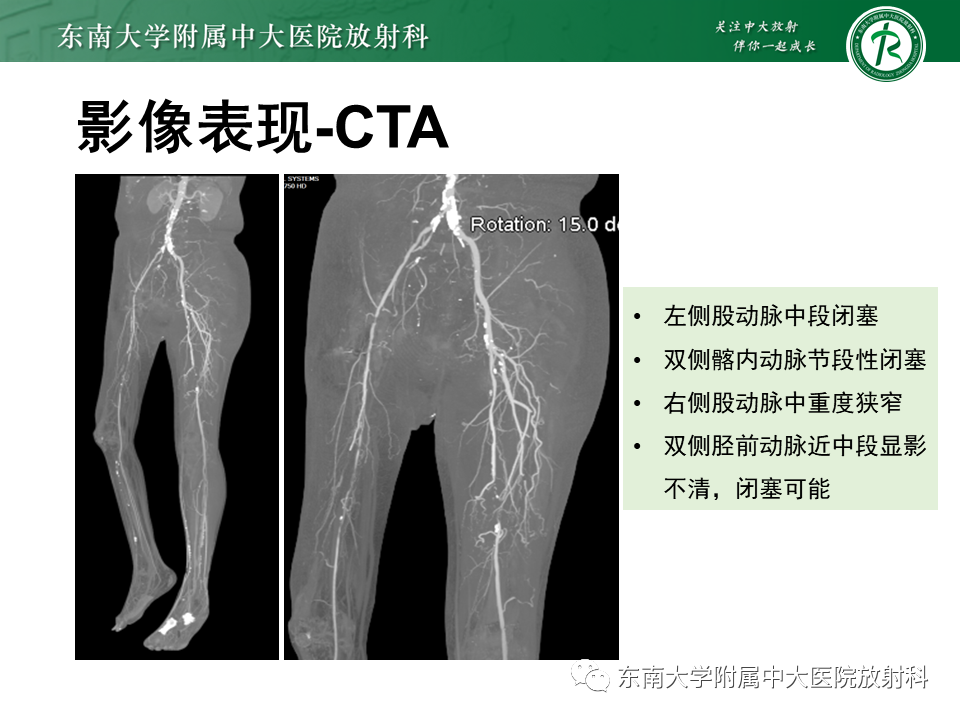 影像PPT - 【PPT】下肢动脉硬化闭塞症-13 影像PPT - 【PPT】下肢动脉硬化闭塞症-13