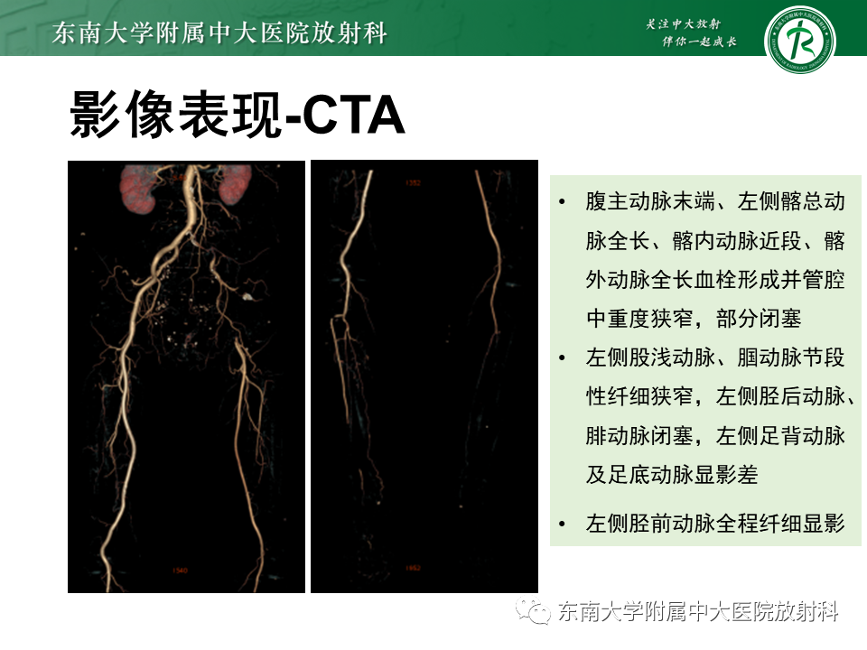 影像PPT - 【PPT】下肢动脉硬化闭塞症-14 影像PPT - 【PPT】下肢动脉硬化闭塞症-14