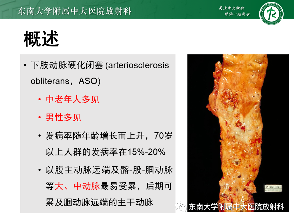 影像PPT - 【PPT】下肢动脉硬化闭塞症-6 影像PPT - 【PPT】下肢动脉硬化闭塞症-6