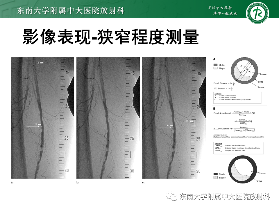 影像PPT - 【PPT】下肢动脉硬化闭塞症-18 影像PPT - 【PPT】下肢动脉硬化闭塞症-18