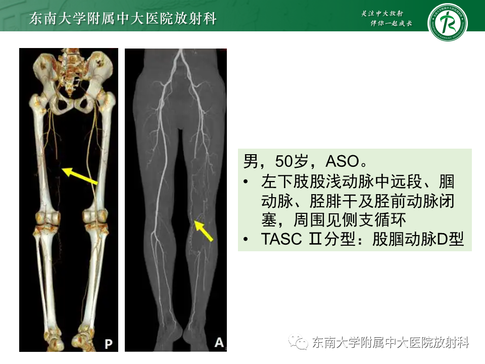 影像PPT - 【PPT】下肢动脉硬化闭塞症-24 影像PPT - 【PPT】下肢动脉硬化闭塞症-24