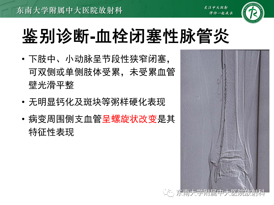 影像PPT - 【PPT】下肢动脉硬化闭塞症-27 影像PPT - 【PPT】下肢动脉硬化闭塞症-27