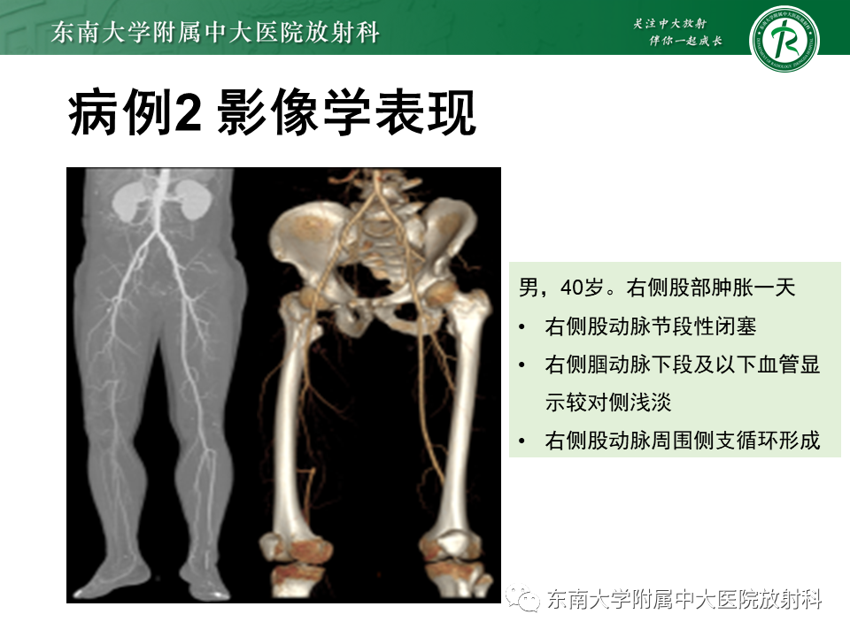 影像PPT - 【PPT】下肢动脉硬化闭塞症-30 影像PPT - 【PPT】下肢动脉硬化闭塞症-30
