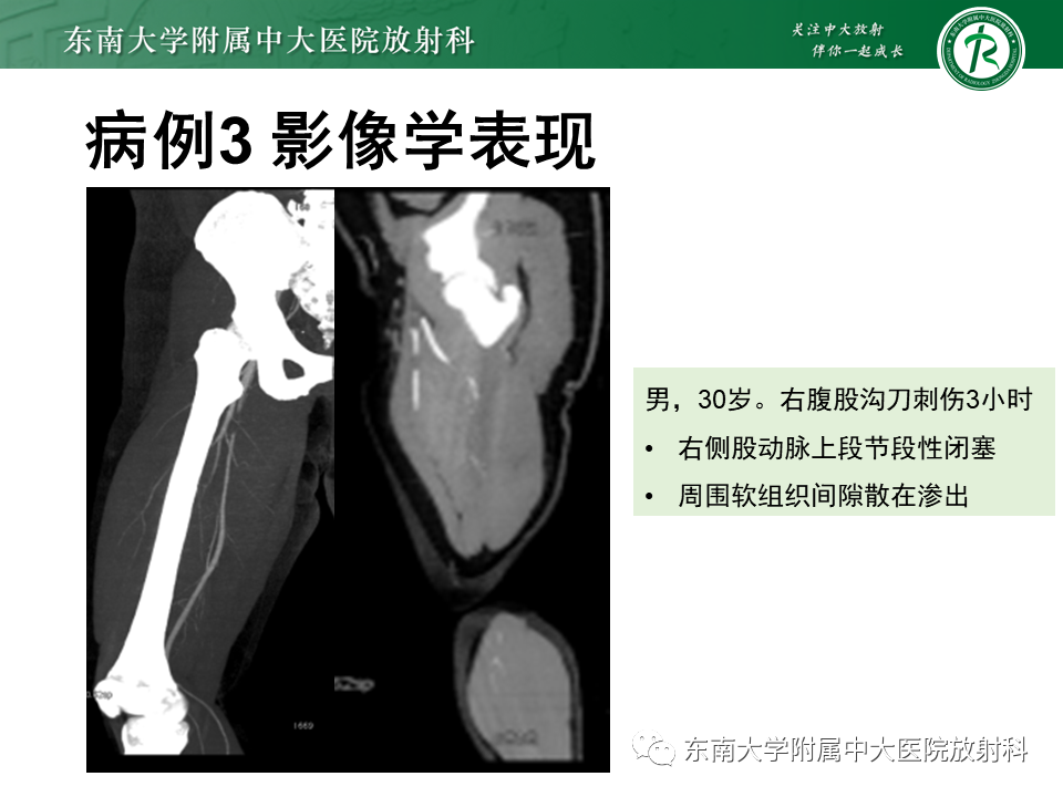 影像PPT - 【PPT】下肢动脉硬化闭塞症-32 影像PPT - 【PPT】下肢动脉硬化闭塞症-32