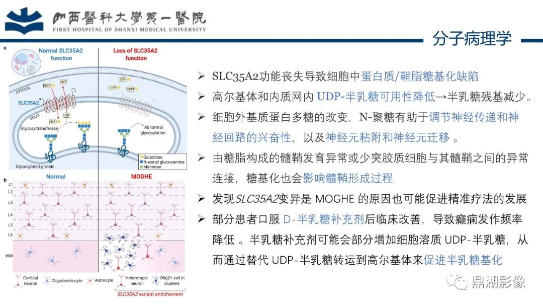 影像PPT - 【PPT】MOGHE的MRI诊断与鉴别诊断-8 影像PPT - 【PPT】MOGHE的MRI诊断与鉴别诊断-8