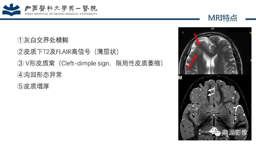 影像PPT - 【PPT】MOGHE的MRI诊断与鉴别诊断-11 影像PPT - 【PPT】MOGHE的MRI诊断与鉴别诊断-11