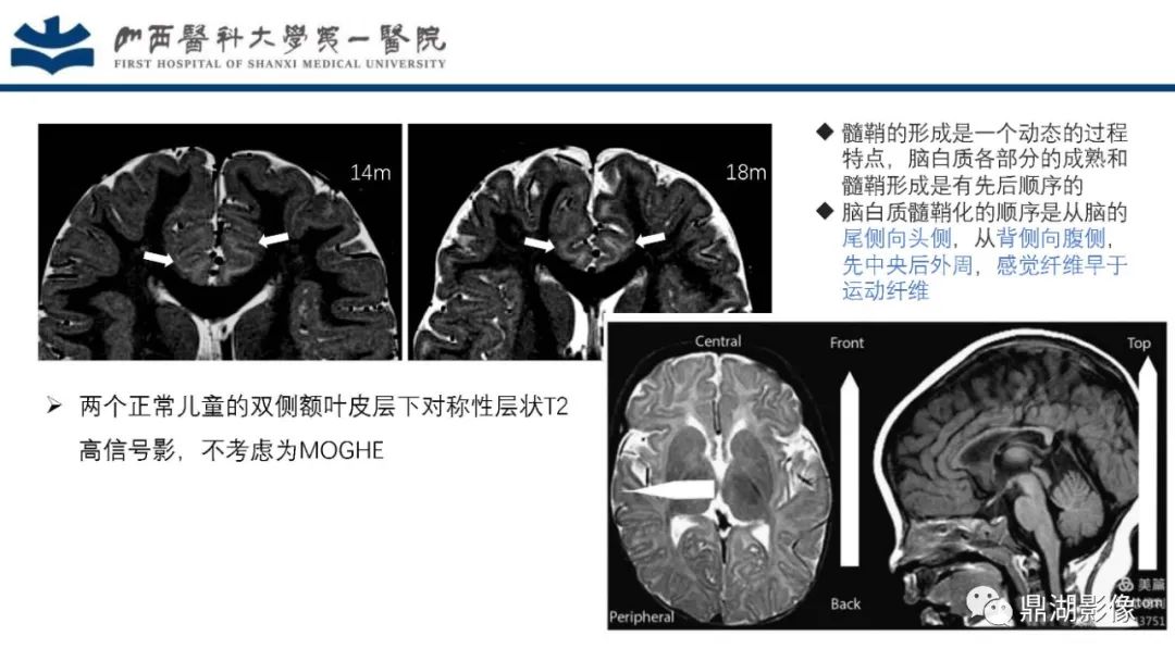 影像PPT - 【PPT】MOGHE的MRI诊断与鉴别诊断-19 影像PPT - 【PPT】MOGHE的MRI诊断与鉴别诊断-19