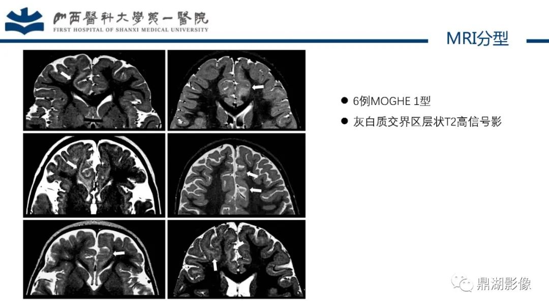 影像PPT - 【PPT】MOGHE的MRI诊断与鉴别诊断-14 影像PPT - 【PPT】MOGHE的MRI诊断与鉴别诊断-14
