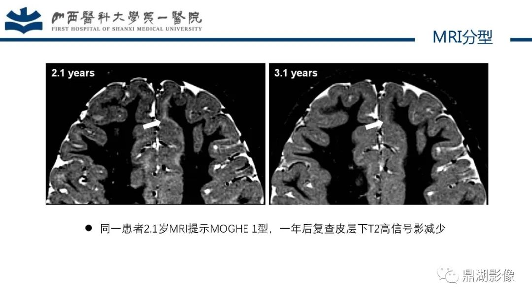 影像PPT - 【PPT】MOGHE的MRI诊断与鉴别诊断-17 影像PPT - 【PPT】MOGHE的MRI诊断与鉴别诊断-17
