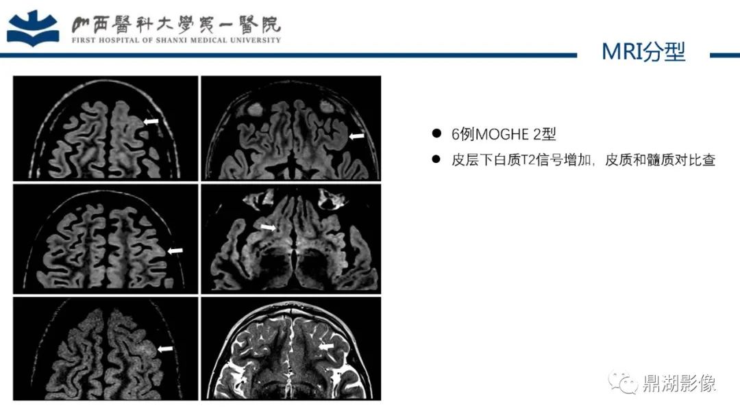 影像PPT - 【PPT】MOGHE的MRI诊断与鉴别诊断-15 影像PPT - 【PPT】MOGHE的MRI诊断与鉴别诊断-15