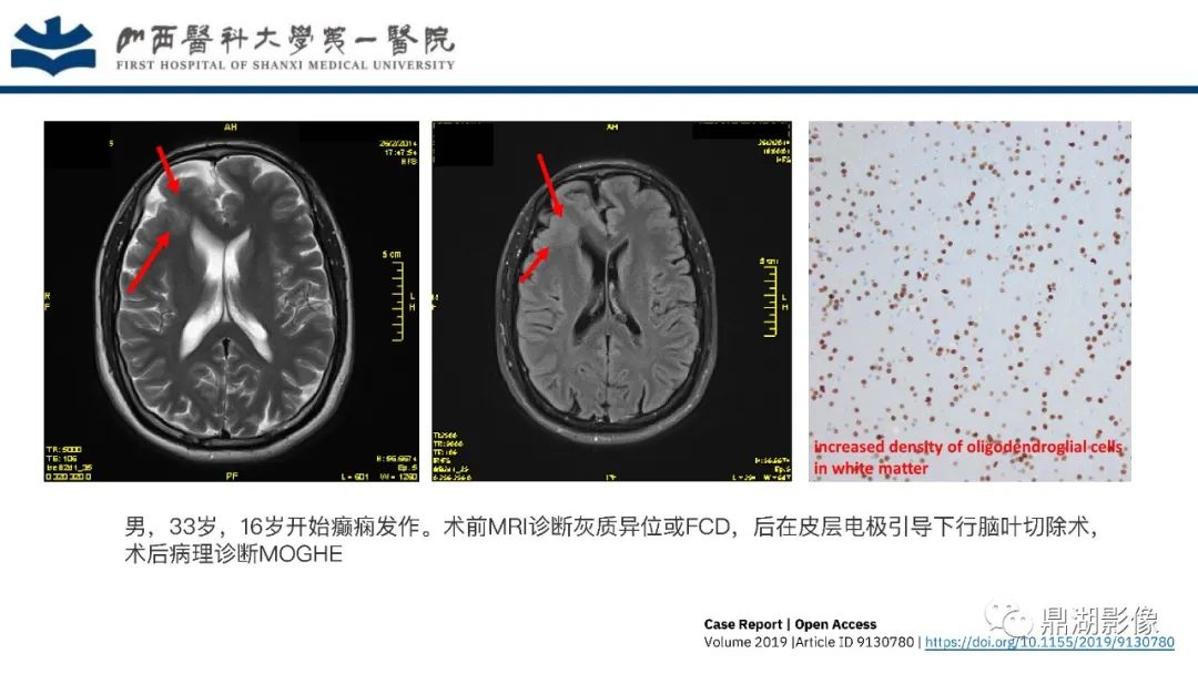 影像PPT - 【PPT】MOGHE的MRI诊断与鉴别诊断-21 影像PPT - 【PPT】MOGHE的MRI诊断与鉴别诊断-21