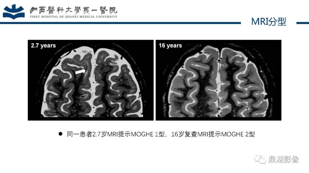 影像PPT - 【PPT】MOGHE的MRI诊断与鉴别诊断-16 影像PPT - 【PPT】MOGHE的MRI诊断与鉴别诊断-16