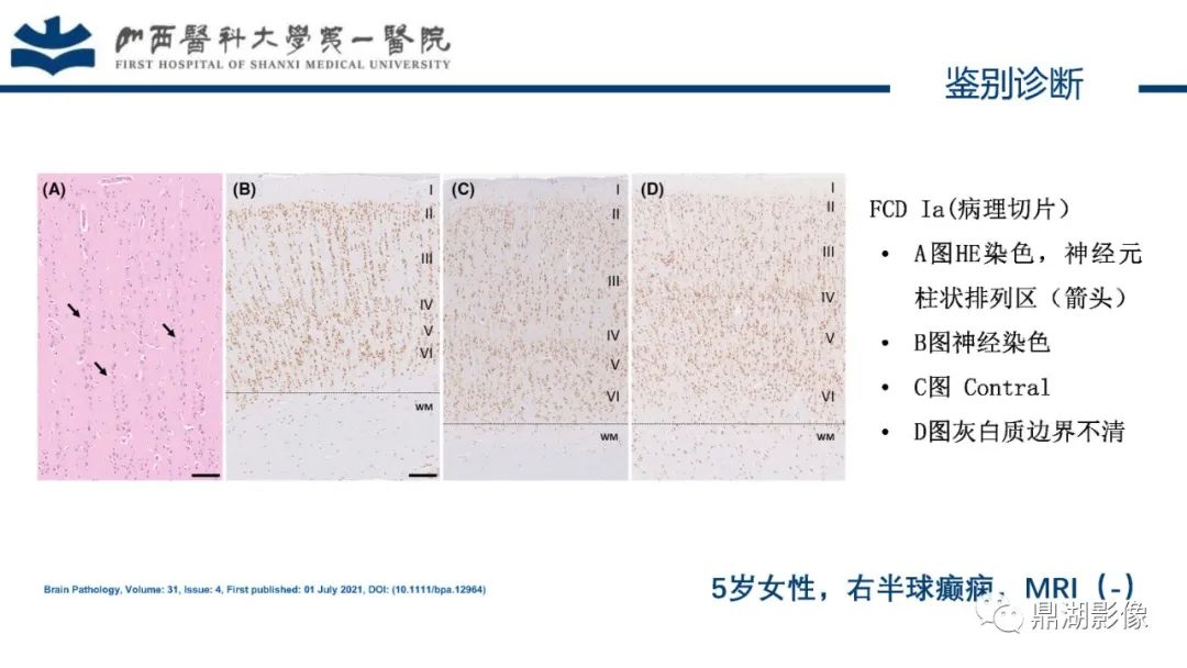 影像PPT - 【PPT】MOGHE的MRI诊断与鉴别诊断-26 影像PPT - 【PPT】MOGHE的MRI诊断与鉴别诊断-26
